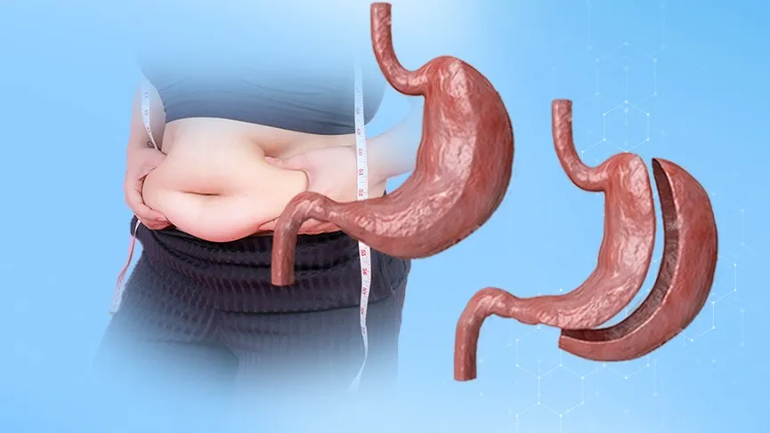Obezite Ameliyatı Öncesi Yapılması Gereken 3 Şey