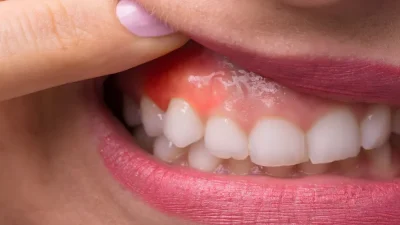 Diş eti çekilmesi, diş köklerinin açığa çıkmasıyla hem estetik sorunlara