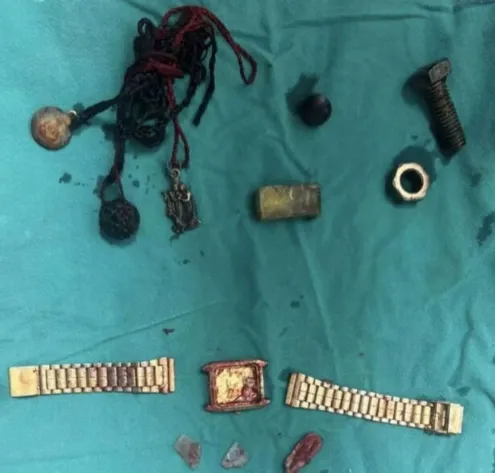 Hindistan’da şiddetli mide ağrısı şikayetiyle hastaneye kaldırılan bir adamın yemek