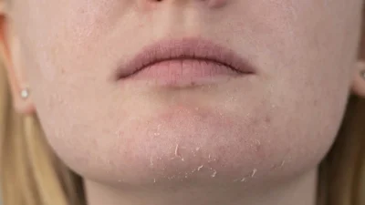 Soğuk hava, rüzgâr ve düşük nem oranı kış aylarında cildin