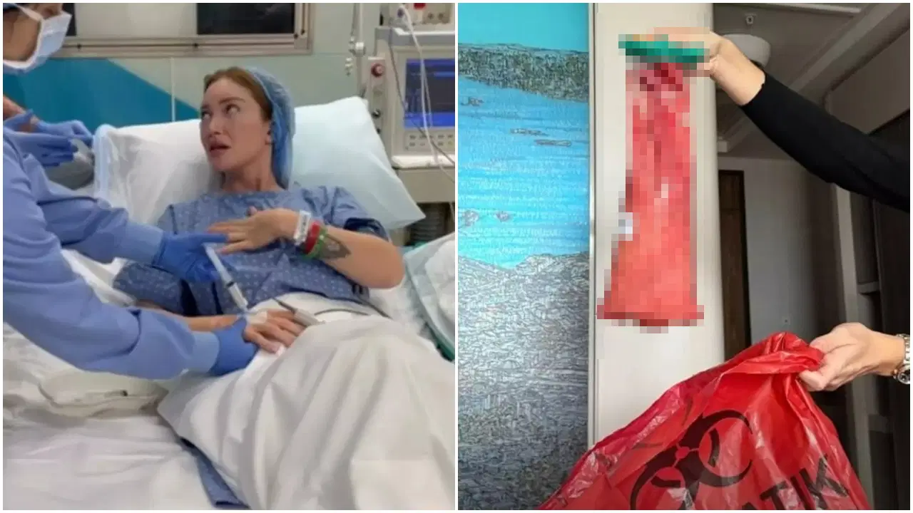 Danla Bilic’ten 'kalça dolgusu' uyarısı: Beşinci ameliyatından çıkan maddeyi paylaştı